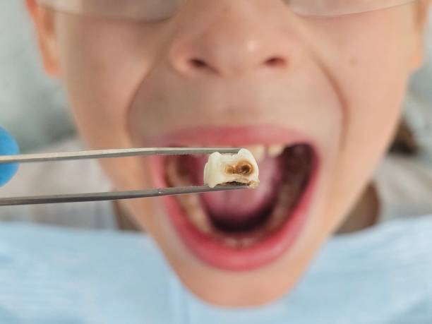 Best Emergency Wisdom Teeth Removal in Elkton, MD